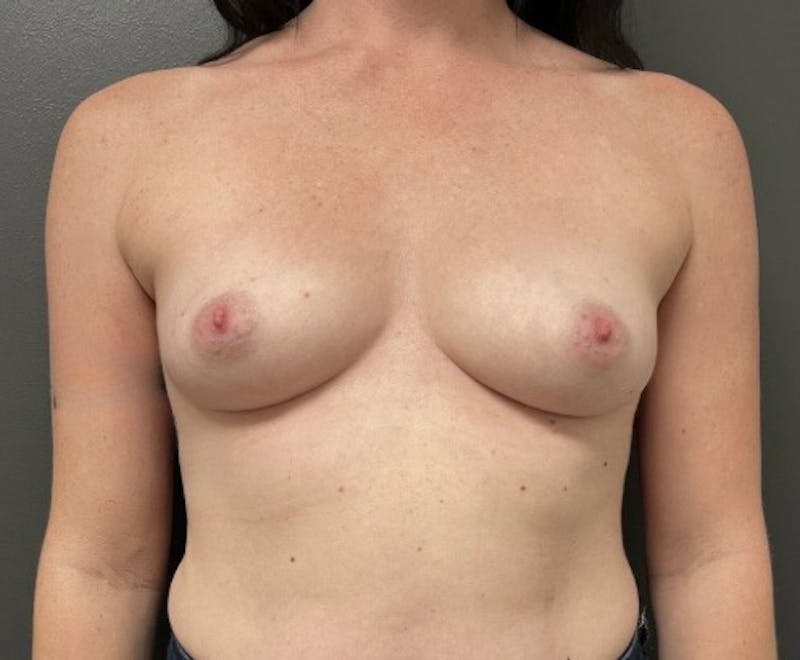 Breast Augmentation Before & After Gallery - Patient 352311 - Image 1