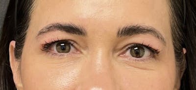 Blepharoplasty Before & After Gallery - Patient 210157 - Image 1