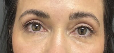 Blepharoplasty Before & After Gallery - Patient 210157 - Image 2