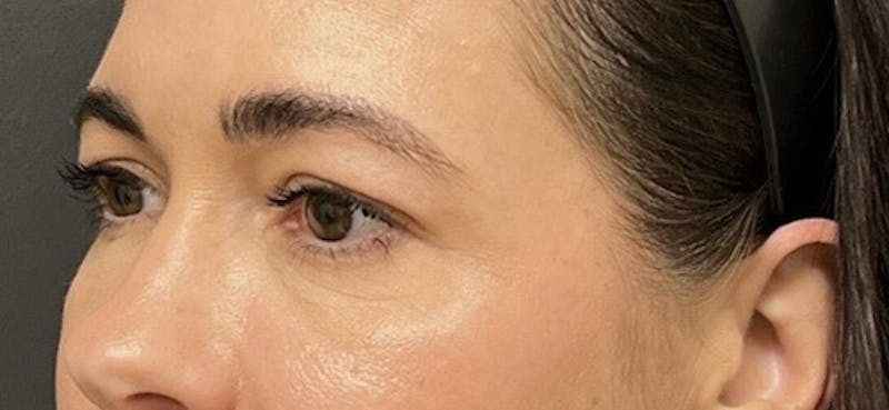 Blepharoplasty Before & After Gallery - Patient 210157 - Image 3
