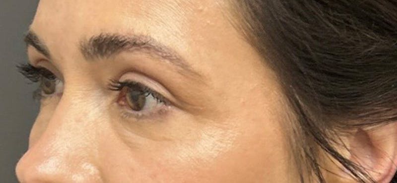 Blepharoplasty Before & After Gallery - Patient 210157 - Image 4
