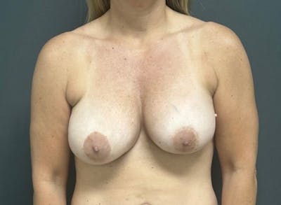 Breast Augmentation with Lift Before & After Gallery - Patient 443133 - Image 1