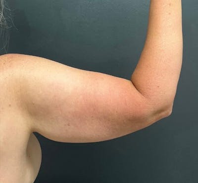 Arm Lift Before & After Gallery - Patient 458748 - Image 1
