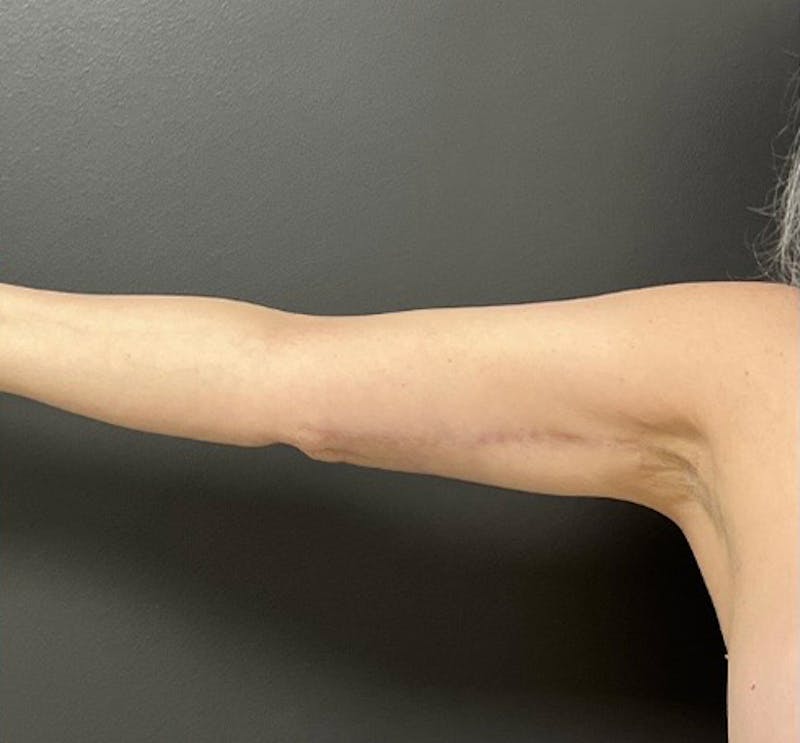 Brachioplasty (Arm Lift) Before & After Gallery - Patient 458748 - Image 6