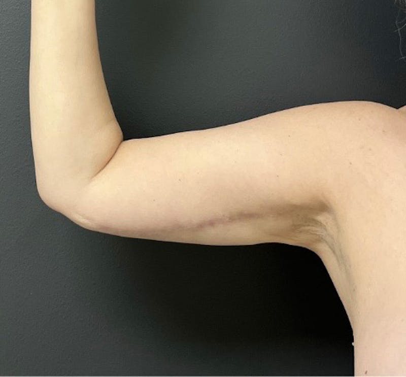 Brachioplasty (Arm Lift) Before & After Gallery - Patient 458748 - Image 4