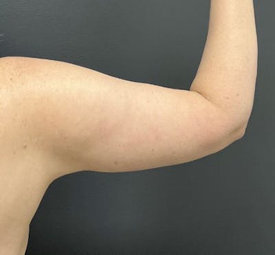 Arm Lift Before & After Gallery - Patient 458748 - Image 2