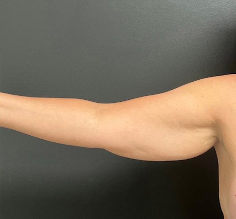 Brachioplasty (Arm Lift) Before & After Gallery - Patient 458748 - Image 5