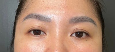 Blepharoplasty Before & After Gallery - Patient 344045 - Image 1