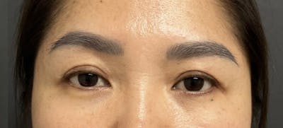 Blepharoplasty Before & After Gallery - Patient 344045 - Image 2