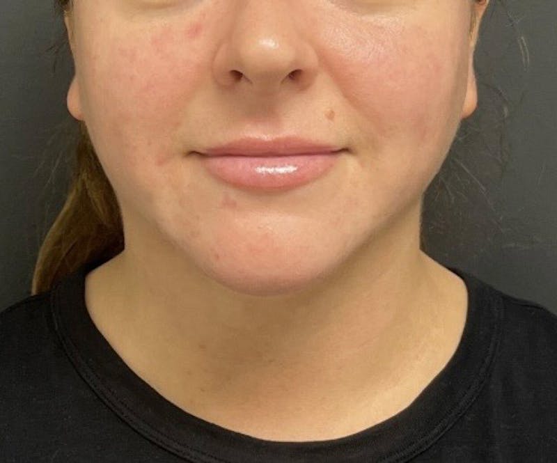 Submental Liposuction Before & After Gallery - Patient 277229 - Image 4
