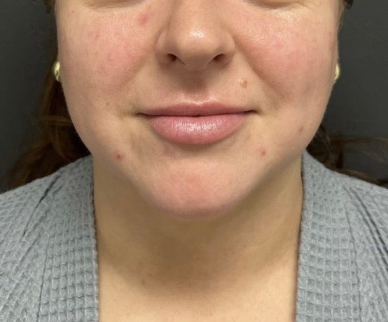 Submental Liposuction Before & After Gallery - Patient 277229 - Image 3