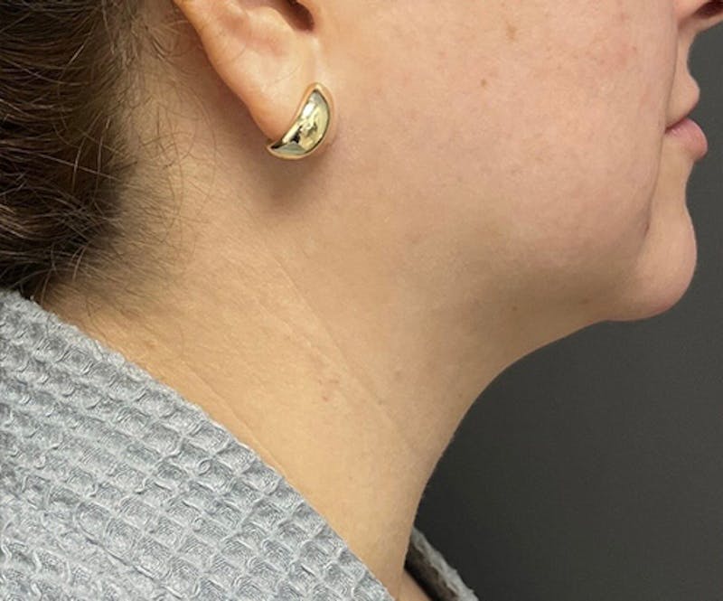 Submental Liposuction Before & After Gallery - Patient 277229 - Image 1