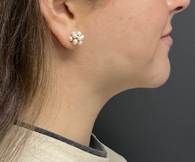 Submental Liposuction Before & After Gallery - Patient 277229 - Image 2