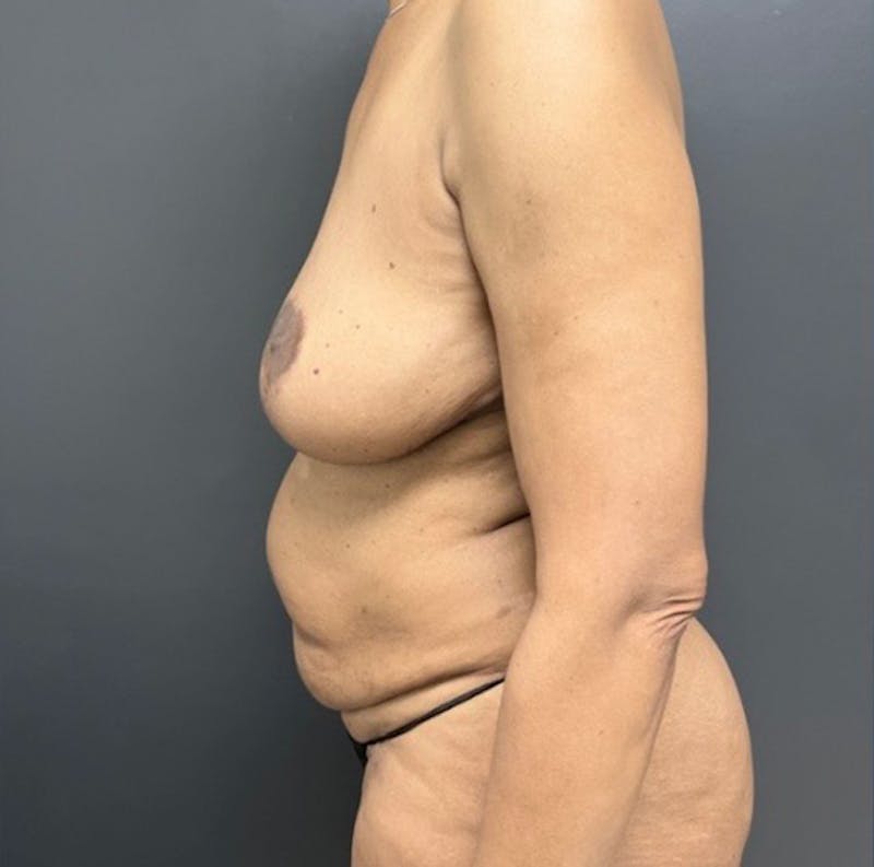 Abdominoplasty (Tummy Tuck) Before & After Gallery - Patient 390157 - Image 6