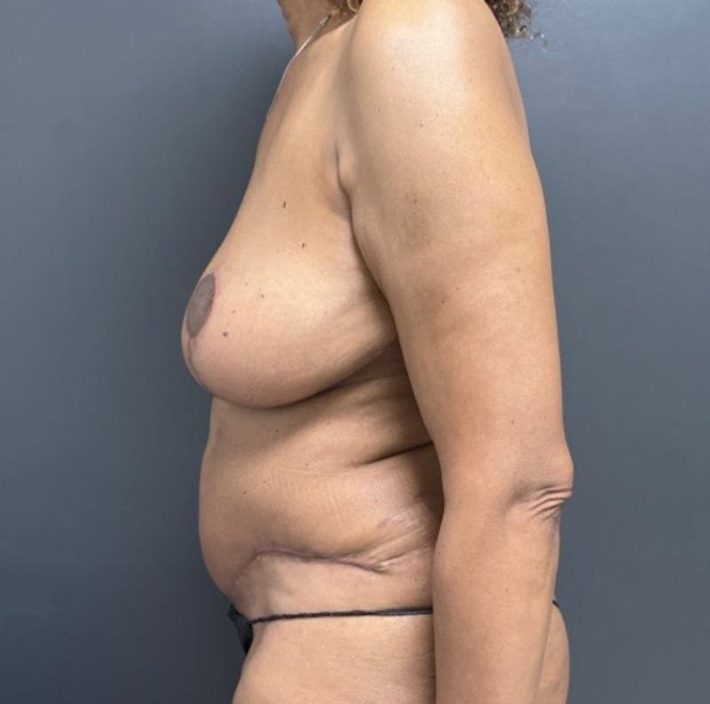 Abdominoplasty (Tummy Tuck) Before & After Gallery - Patient 390157 - Image 5