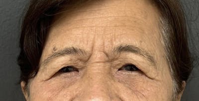 Blepharoplasty Before & After Gallery - Patient 171107 - Image 1