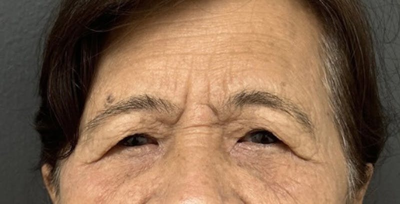 Blepharoplasty Before & After Gallery - Patient 171107 - Image 1