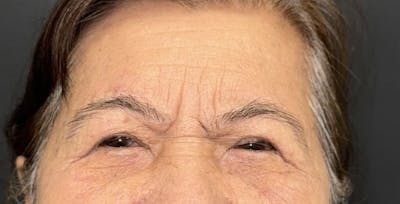 Blepharoplasty Before & After Gallery - Patient 171107 - Image 2