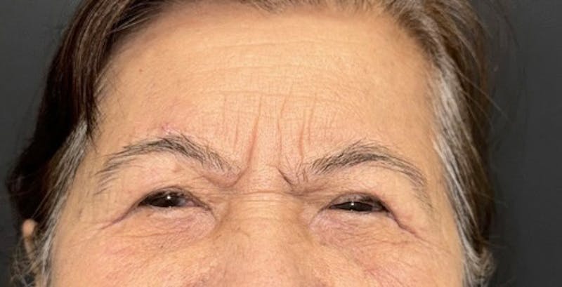 Blepharoplasty Before & After Gallery - Patient 171107 - Image 2
