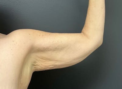 Arm Lift Before & After Gallery - Patient 534870 - Image 1
