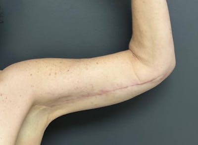 Arm Lift Before & After Gallery - Patient 534870 - Image 2