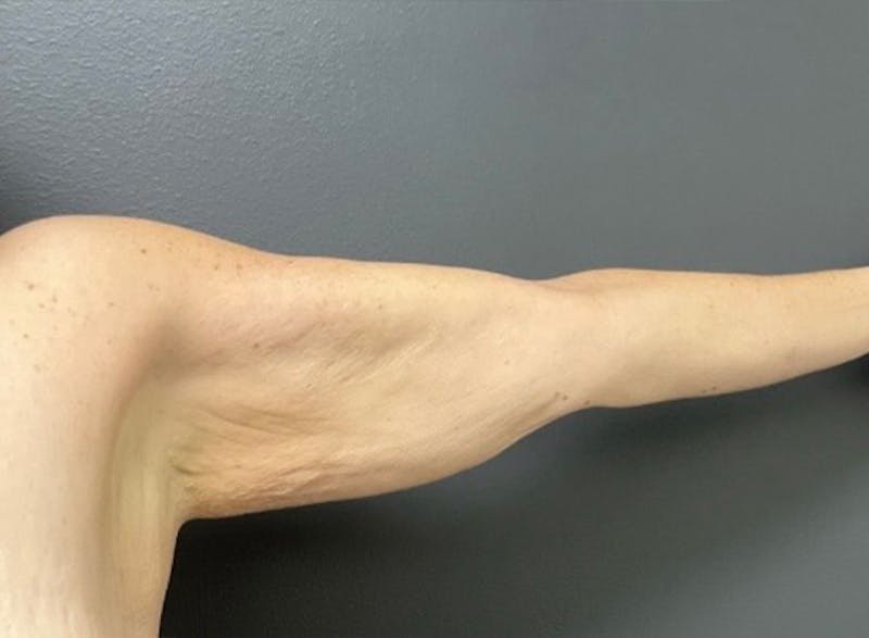 Brachioplasty (Arm Lift) Before & After Gallery - Patient 534870 - Image 7