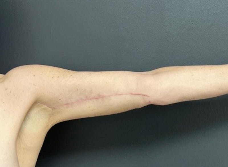 Brachioplasty (Arm Lift) Before & After Gallery - Patient 534870 - Image 8
