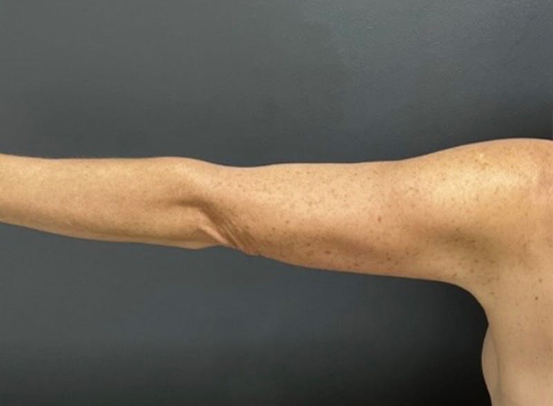Brachioplasty (Arm Lift) Before & After Gallery - Patient 534870 - Image 6