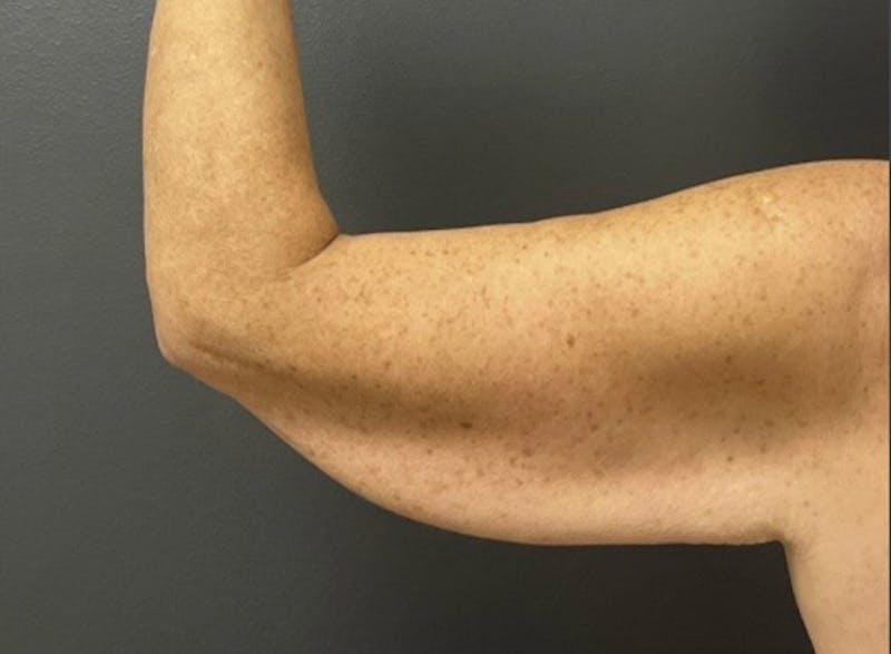 Brachioplasty (Arm Lift) Before & After Gallery - Patient 534870 - Image 3