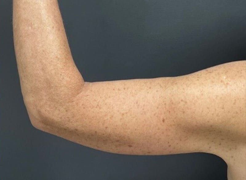 Brachioplasty (Arm Lift) Before & After Gallery - Patient 534870 - Image 4