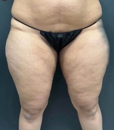 Thighplasty (Thigh Lift) Before & After Gallery - Patient 134173 - Image 1