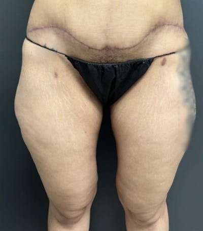 Thighplasty (Thigh Lift) Before & After Gallery - Patient 134173 - Image 2