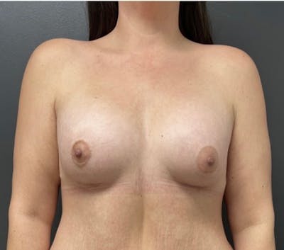 Breast Augmentation Before & After Gallery - Patient 103795 - Image 2