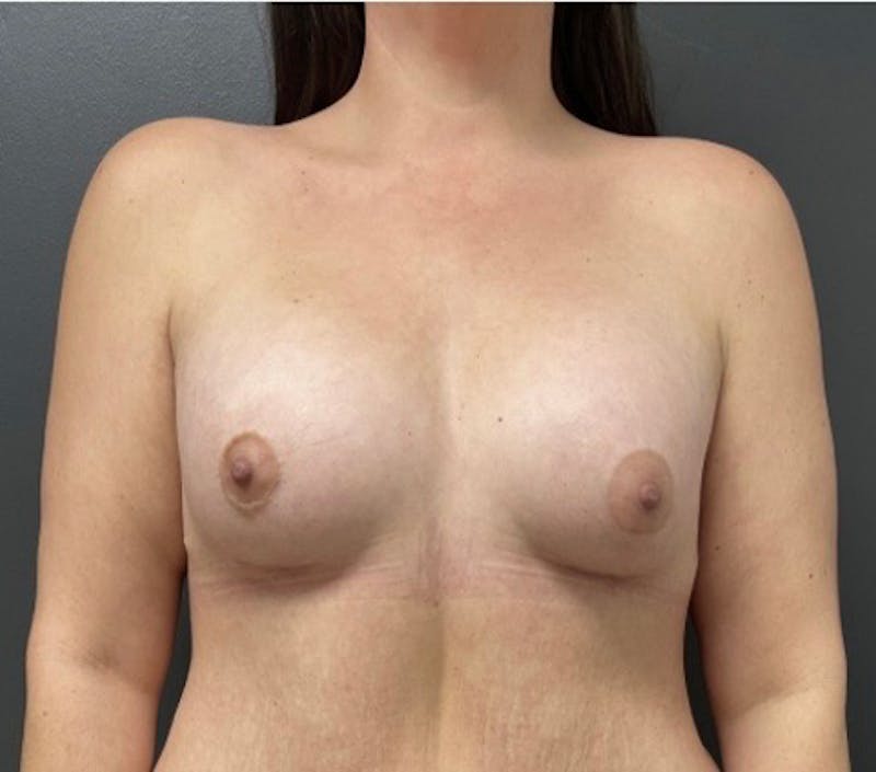 Breast Augmentation Before & After Gallery - Patient 103795 - Image 2