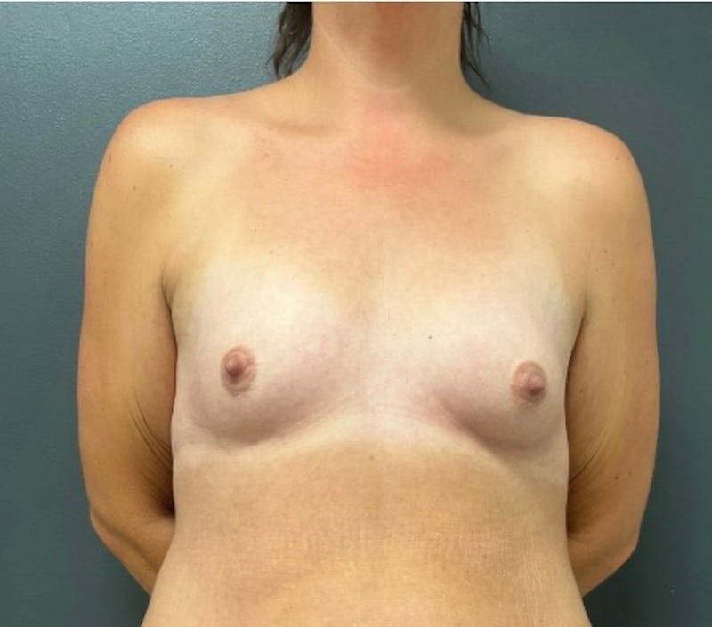 Breast Augmentation Before & After Gallery - Patient 103795 - Image 1