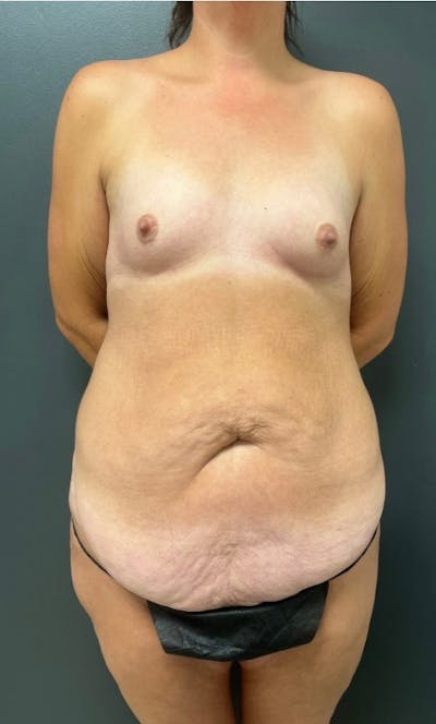 Tummy Tuck Before & After Gallery - Patient 203222 - Image 1