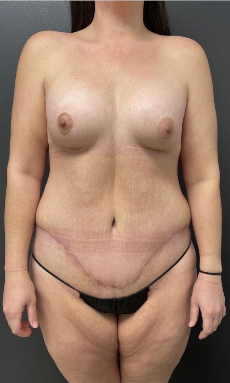 Abdominoplasty (Tummy Tuck) Before & After Gallery - Patient 203222 - Image 2