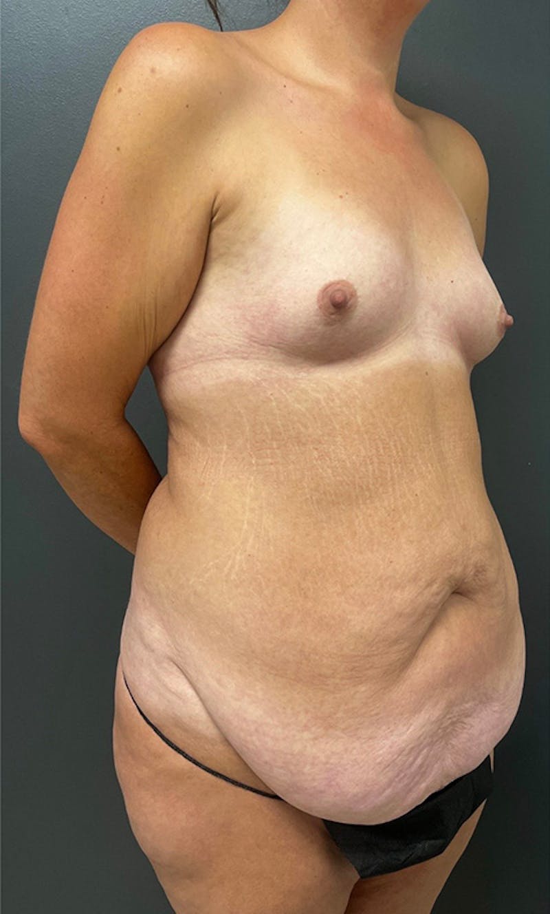 Abdominoplasty (Tummy Tuck) Before & After Gallery - Patient 203222 - Image 3
