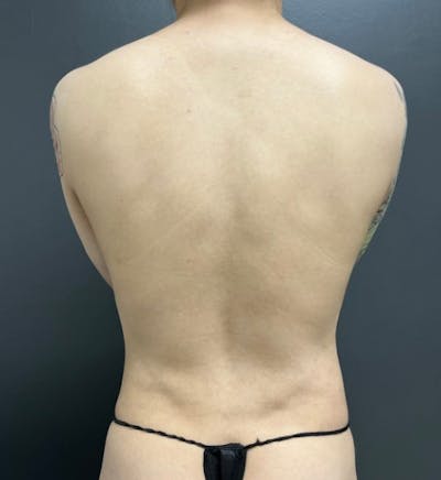 Back Lift Before & After Gallery - Patient 112412 - Image 1