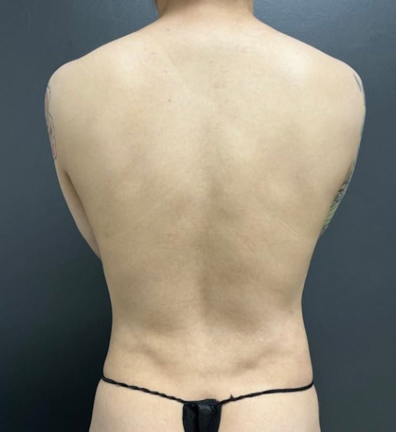 Back Lift Before & After Gallery - Patient 112412 - Image 1