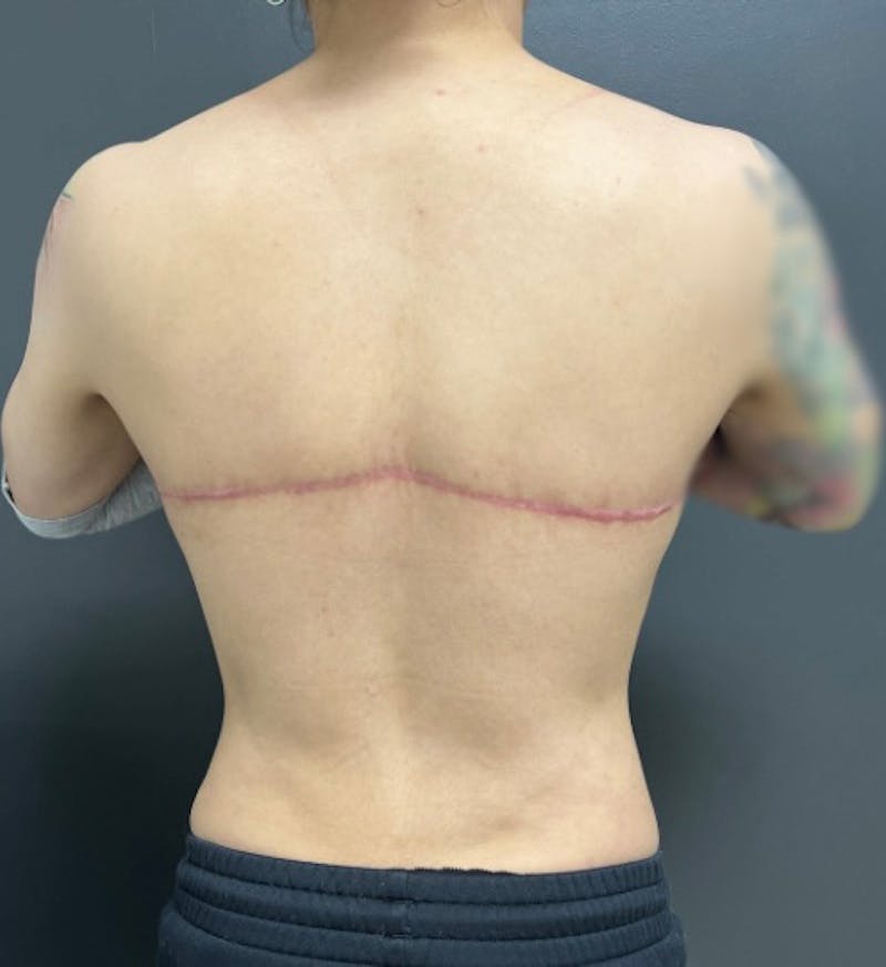 Back Lift Before & After Gallery - Patient 112412 - Image 2