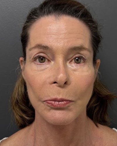 Facelift Before & After Gallery - Patient 176913 - Image 2