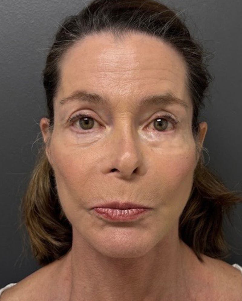 Facelift Before & After Gallery - Patient 176913 - Image 2