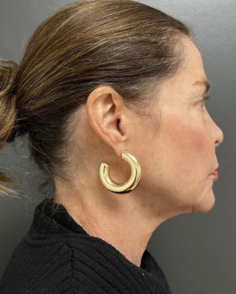 Facelift Before & After Gallery - Patient 176913 - Image 3