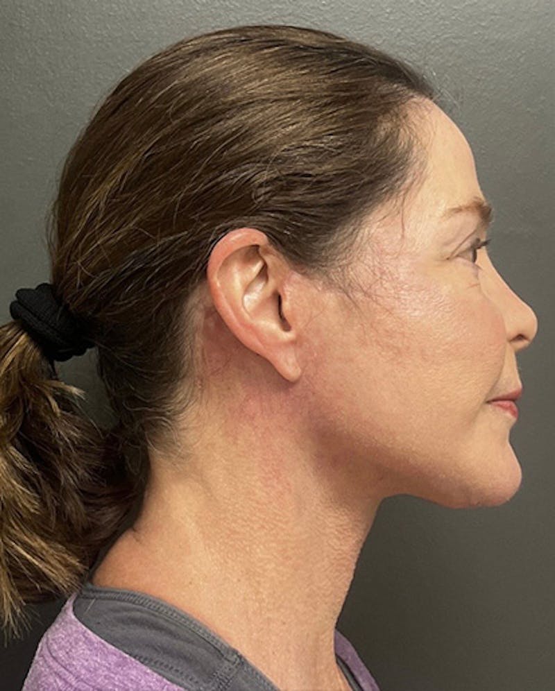 Facelift Before & After Gallery - Patient 176913 - Image 4