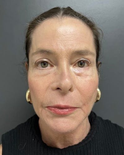 Facelift Before & After Gallery - Patient 176913 - Image 1