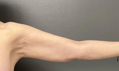 Arm Lift Before & After Gallery - Patient 291389 - Image 1