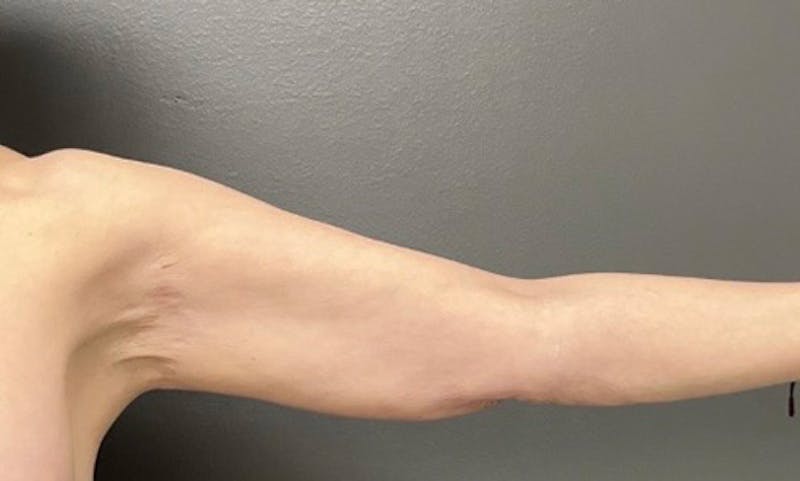 Brachioplasty (Arm Lift) Before & After Gallery - Patient 291389 - Image 1