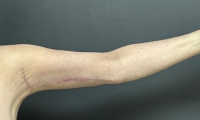 Arm Lift Before & After Gallery - Patient 291389 - Image 2