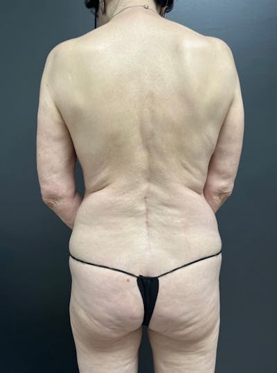 Back Lift Before & After Gallery - Patient 152617 - Image 1